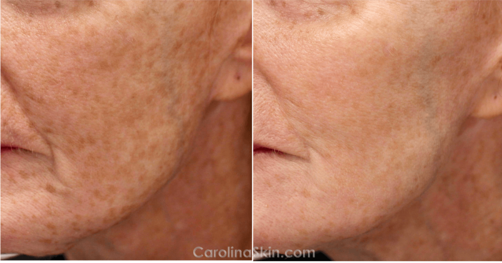 lasemd before and after pictures of female face