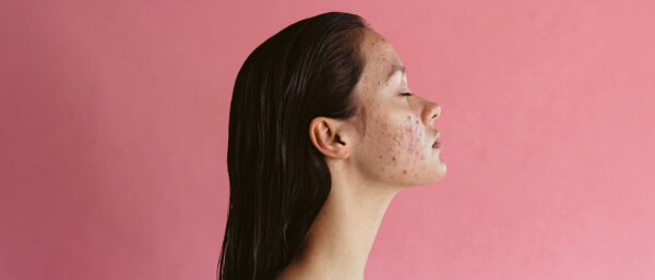 Acne Scarring