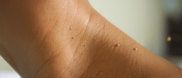Birthmarks Benign Growths