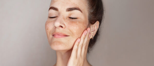 CosmeticDerm-Melasma-905241490 Melasma